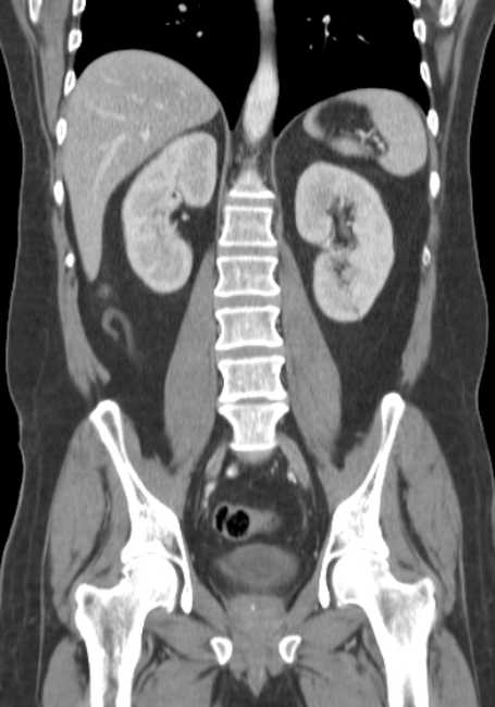 Bleeding duodenal ulcer and adenomyomatosis of gallbladder (Radiopaedia 61834-69861 B 32).jpg