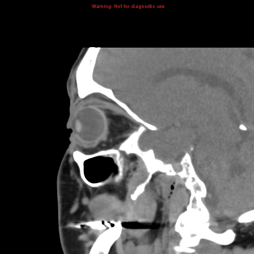 File:Blowout fracture with inferior rectus entrapment (Radiopaedia 12418-12673 C 8).jpg