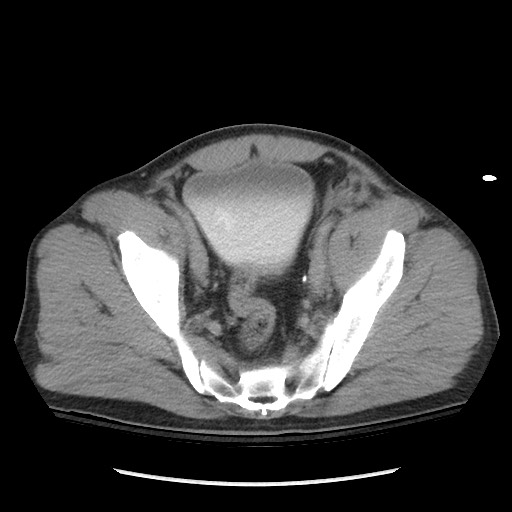 Blunt abdominal trauma with solid organ and musculoskelatal injury with active extravasation (Radiopaedia 68364-77895 Axial C+ delayed 117).jpg