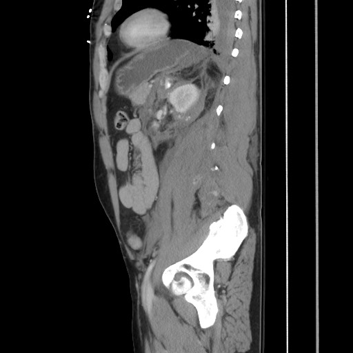 Blunt abdominal trauma with solid organ and musculoskelatal injury with active extravasation (Radiopaedia 68364-77895 C 100).jpg