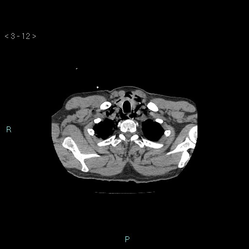 Boerhaave syndrome (Radiopaedia 27683-27897 Axial non-contrast 12).jpg