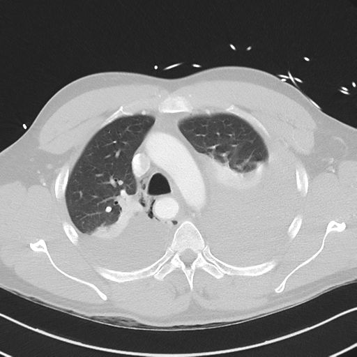 Boerhaave syndrome (Radiopaedia 39382-41661 Axial lung window 17).png