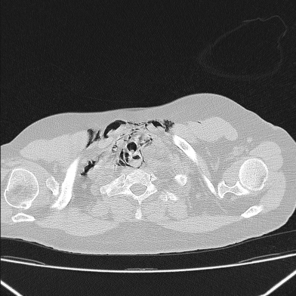 Boerhaave syndrome (Radiopaedia 45644-49799 Axial lung window 26).jpg