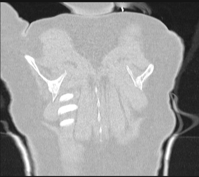 Boerhaave syndrome (Radiopaedia 45644-49799 Coronal lung window 67).jpg