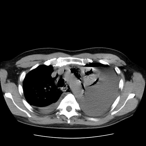 Boerhaave syndrome (Radiopaedia 59796-67310 Axial liver window 21).jpg