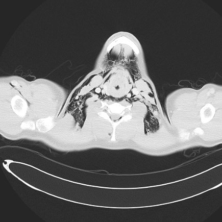 Boerhaave syndrome with mediastinal, axillary, neck and epidural free gas (Radiopaedia 41297-44115 Axial lung window 21).jpg