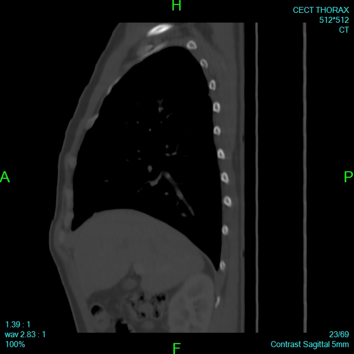Bone metastases from lung carcinoma (Radiopaedia 54703-60937 Sagittal bone window 23).jpg