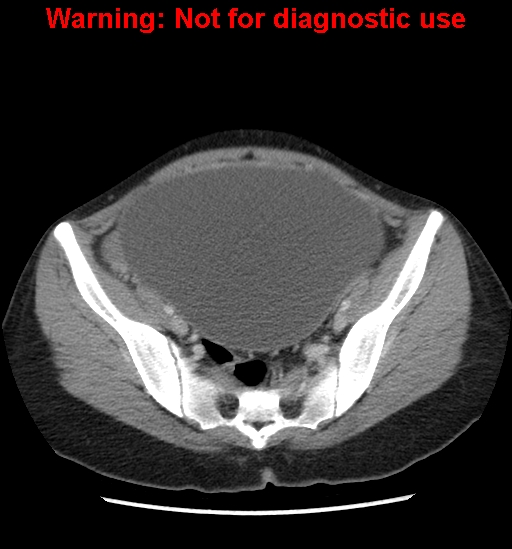 Borderline mucinous cystadenoma of ovary (Radiopaedia 25586-25767 A 85).jpg