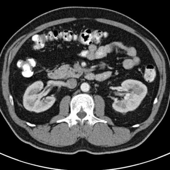 File:Bosniak cyst - type IV (Radiopaedia 23525-23627 renal cortical phase 26).jpg
