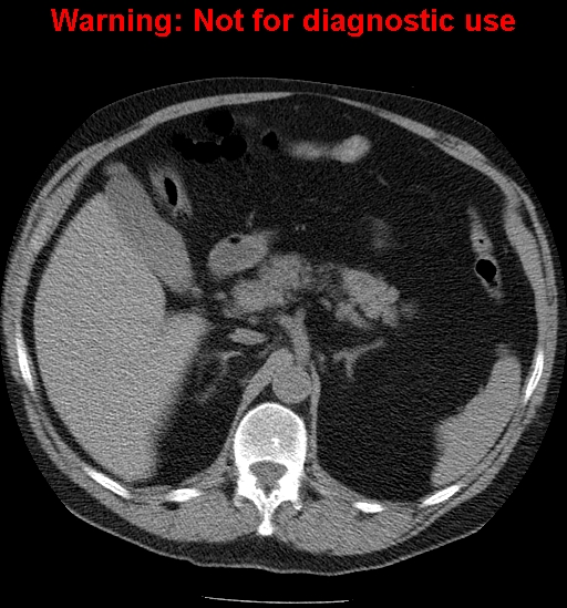 File:Bosniak renal cyst - type IV (Radiopaedia 23402-23466 Axial non-contrast 5).jpg