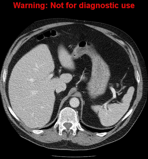 File:Bosniak renal cyst - type IV (Radiopaedia 23402-23466 D 15).jpg