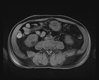 Bouveret syndrome (Radiopaedia 61017-68856 Axial T1 fat sat 59).jpg