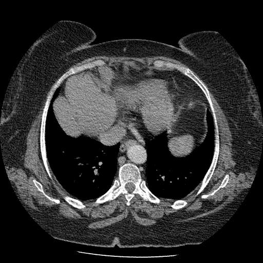 Bovine aortic arch - right internal mammary vein drains into the superior vena cava (Radiopaedia 63296-71875 A 116).jpg