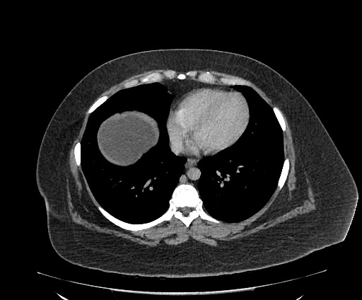 Bowel and splenic infarcts in acute lymphocytic leukemia (Radiopaedia 61055-68913 A 12).jpg