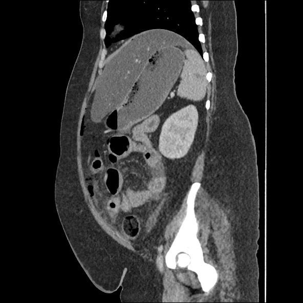 Bowel and splenic infarcts in acute lymphocytic leukemia (Radiopaedia 61055-68915 C 22).jpg