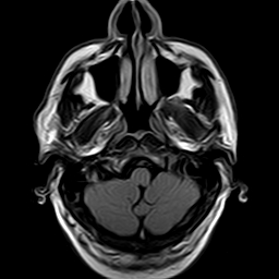 File:Brain abscess complicated by intraventricular rupture and ventriculitis (Radiopaedia 82434-96571 Axial FLAIR 2).jpg