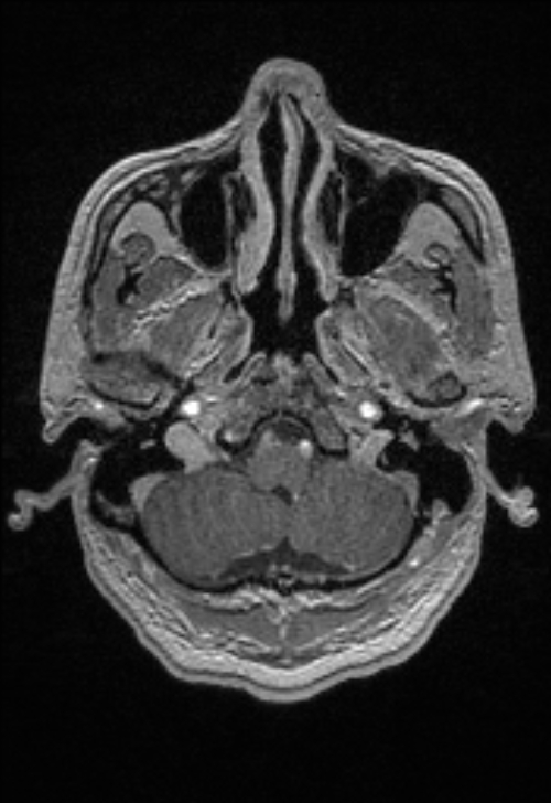 Brain abscess with ventriculitis (Radiopaedia 85703-101495 Axial T1 C+ 33).jpg