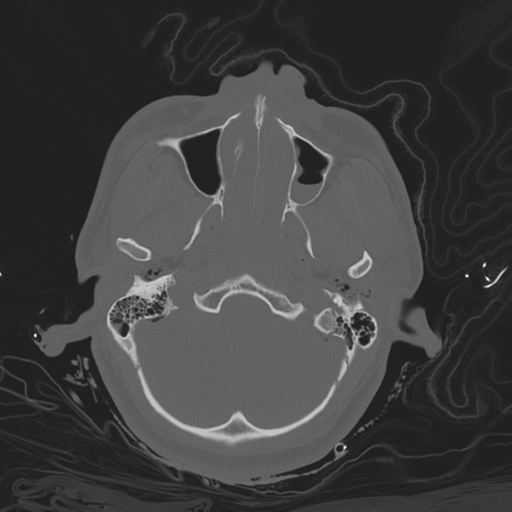 Brain contusions, internal carotid artery dissection and base of skull fracture (Radiopaedia 34089-35339 Axial bone window 47).png
