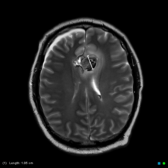 File:Brain death on MRI and CT angiography (Radiopaedia 42560-45689 Axial T2 21).jpg