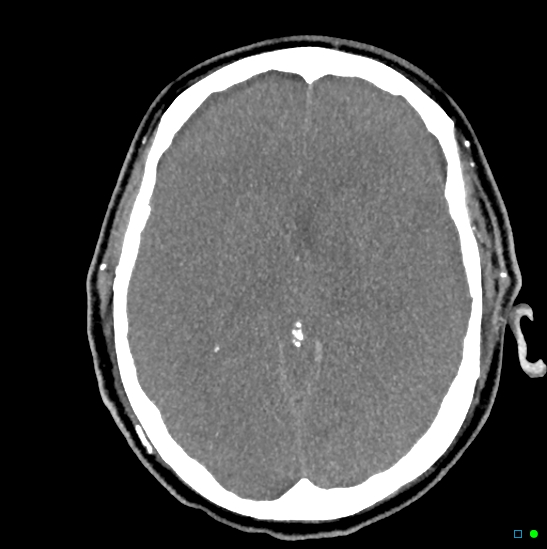 Brain death on MRI and CT angiography (Radiopaedia 42560-45841 B 28).jpg