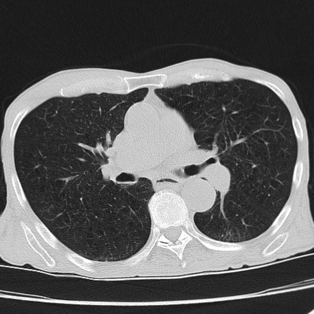 Brain metastases from lung cancer (Radiopaedia 27849-28093 Axial lung window 30).jpg