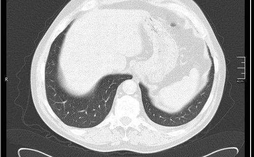 Brain metastases from squamocellular lung cancer (Radiopaedia 56515-63219 Axial lung window 55).jpg