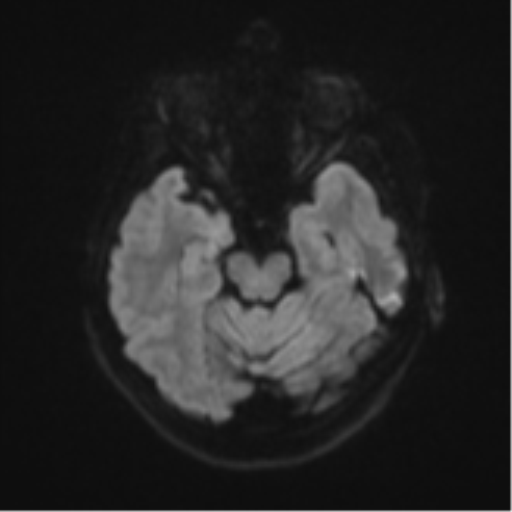 Brain metastasis (sarcoma) (Radiopaedia 47576-52209 Axial DWI 38).png