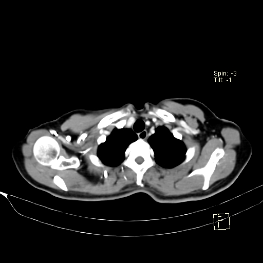 Brain metastasis as initial presentation of non-small cell lung cancer (Radiopaedia 65122-74127 A 6).jpg