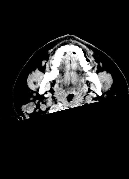Brainstem hemorrhage (Radiopaedia 81294-94976 Axial non-contrast 77).jpg
