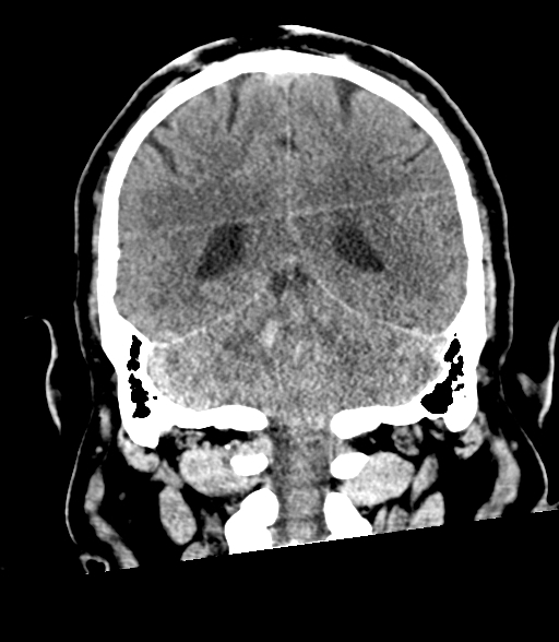 Brainstem hemorrhage (Radiopaedia 81294-94976 Coronal non-contrast 47).jpg