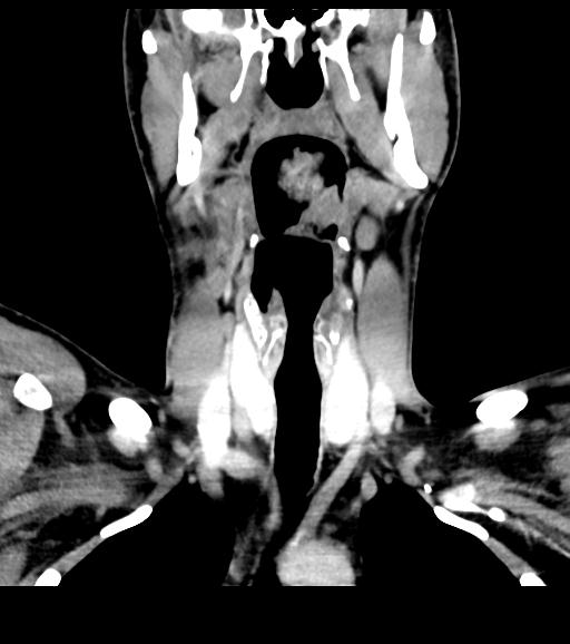 Branchial cleft cyst (Radiopaedia 31167-31875 Coronal C+ delayed 30).jpg