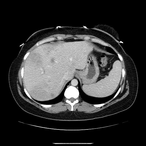 Breast cancer pseudocirrhosis after chemotherapy (Radiopaedia 65407-74456 A 18).jpg