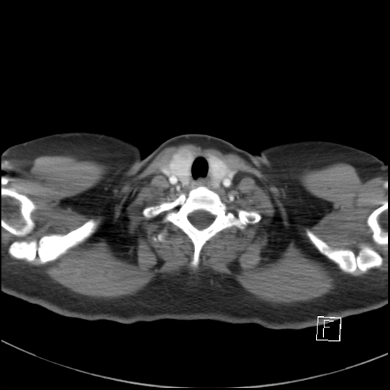 File:Breast metastases from renal cell cancer (Radiopaedia 79220-92225 A 3).jpg