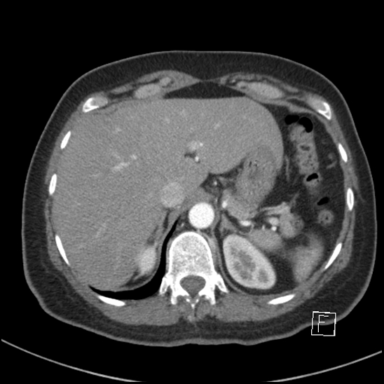 Breast metastases from renal cell cancer (Radiopaedia 79220-92225 A 85).jpg
