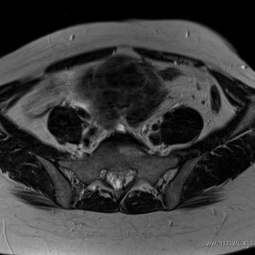 File:Broad ligament fibroid (Radiopaedia 49135-54241 Axial T2 10).jpg