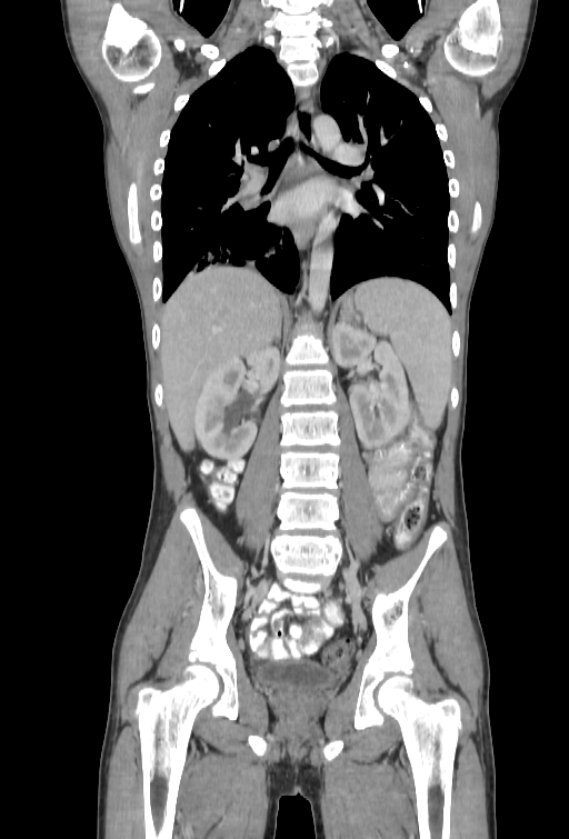 Bronchial carcinoid tumor (Radiopaedia 57187-64090 B 68).jpg