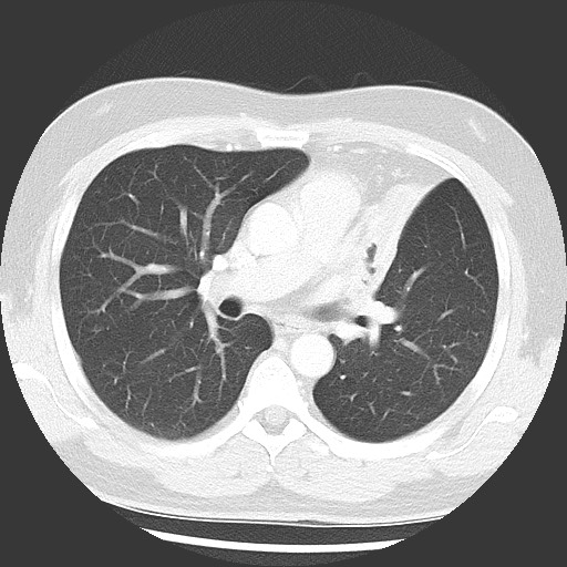 Bronchial carcinoid tumor (Radiopaedia 67377-76764 Axial lung window 30).jpg