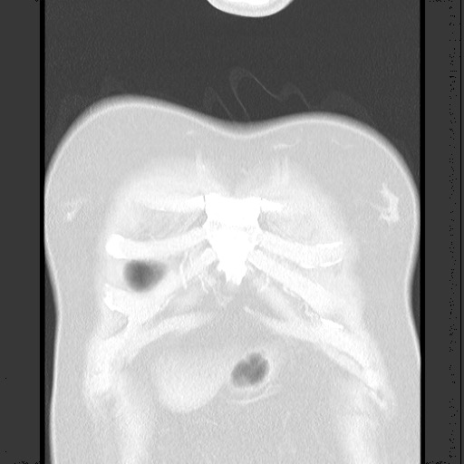 Bronchial carcinoid tumor (Radiopaedia 67377-76764 Coronal lung window 16).jpg
