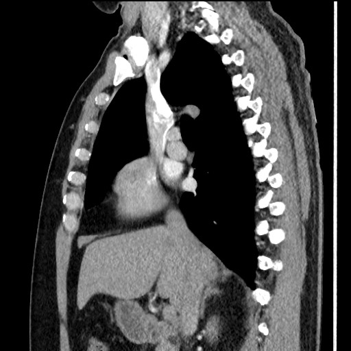 Bronchial carcinoid tumor (Radiopaedia 67377-76764 E 30).jpg
