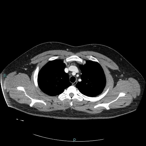 Bronchial carcinoid tumor (Radiopaedia 78272-90875 A 27).jpg