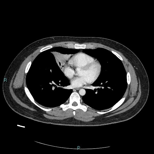 Bronchial carcinoid tumor (Radiopaedia 78272-90875 A 58).jpg