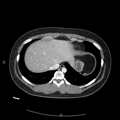 Bronchial carcinoid tumor (Radiopaedia 78272-90875 A 79).jpg