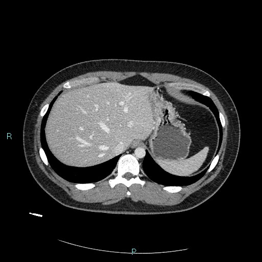 Bronchial carcinoid tumor (Radiopaedia 78272-90875 A 85).jpg