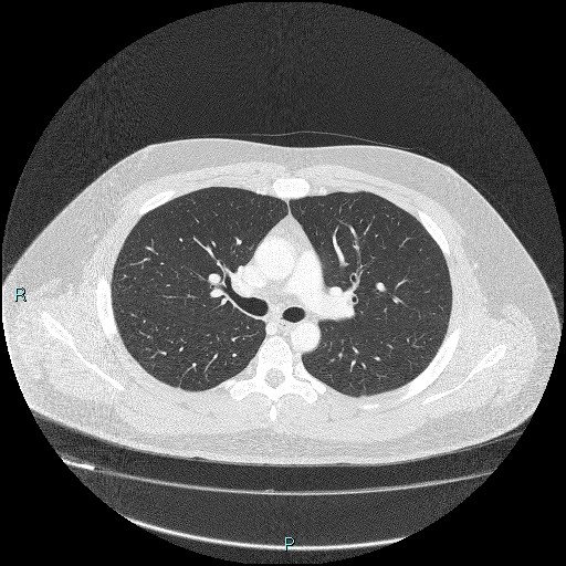 Bronchial carcinoid tumor (Radiopaedia 78272-90875 Axial lung window 19).jpg