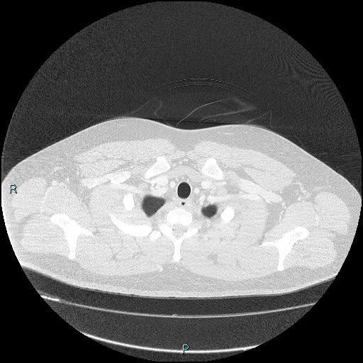Bronchial carcinoid tumor (Radiopaedia 78272-90875 Axial lung window 2).jpg