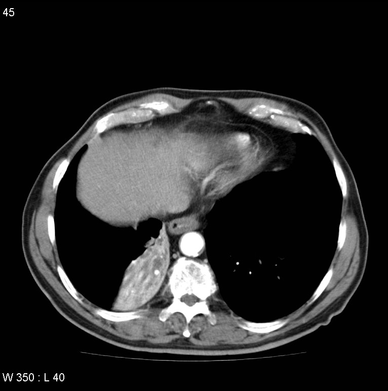 Bronchial carcinoid tumor with right lower lobe collapse (Radiopaedia 29060-29422 A 44).jpg