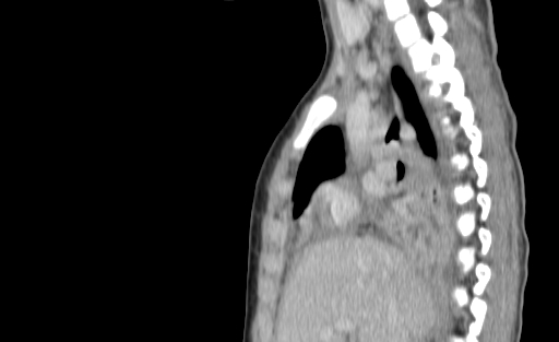 Bronchial mucoepidermoid carcinoma (Radiopaedia 57023-63895 Sagittal 91).jpg