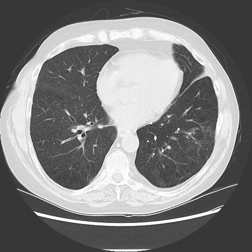 Bronchial stenosis - lung transplant (Radiopaedia 73133-83848 Axial lung window 41).jpg