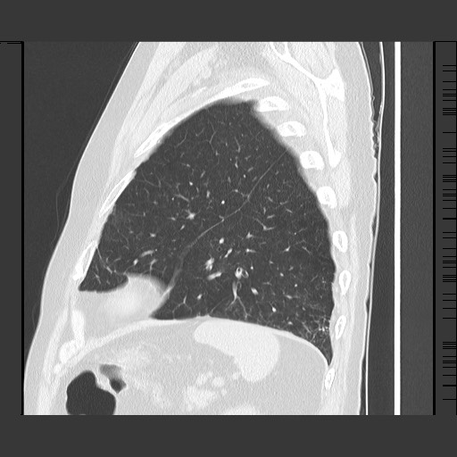 Bronchial stenosis - lung transplant (Radiopaedia 73133-83848 Sagittal lung window 55).jpg