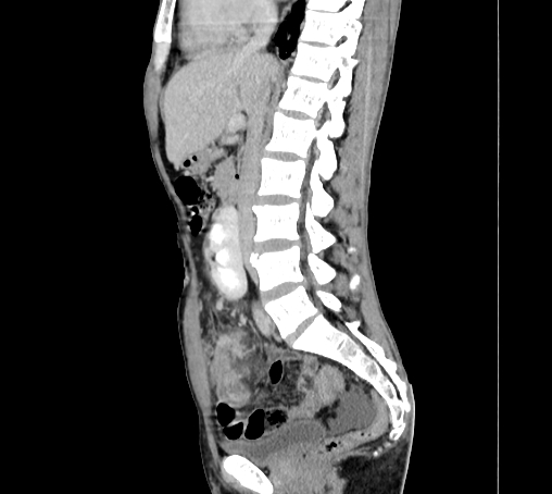 File:Bronchiectasis in Crohn disease (Radiopaedia 60311-67977 D 52).jpg